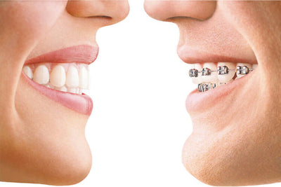 Reasons Why I Don't Do Invisalign