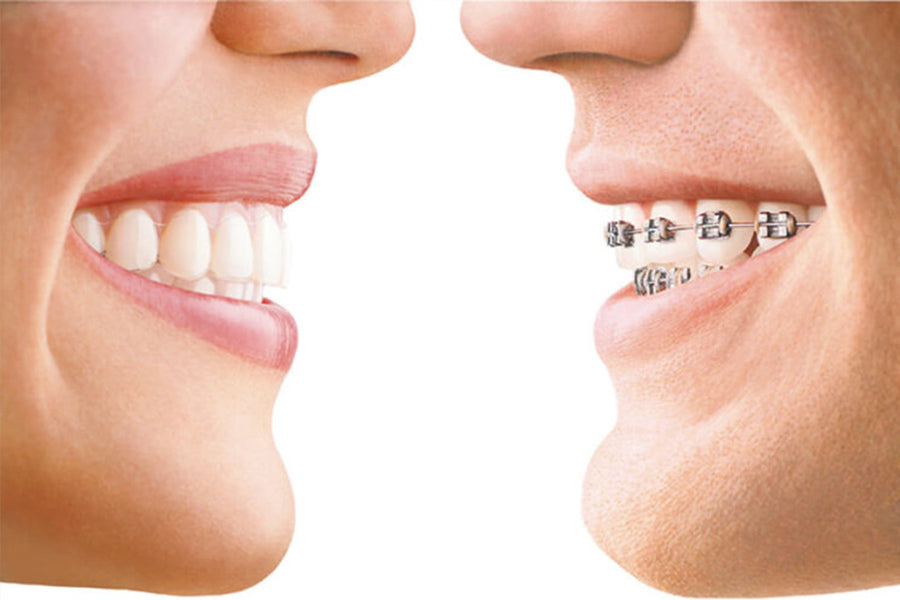 Reasons Why I Don't Do Invisalign